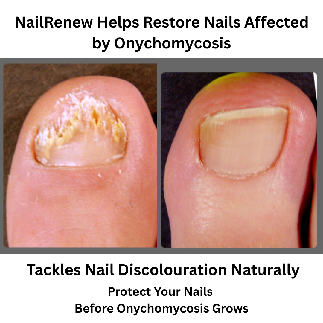 NailRenew Laser Device - Removes Nail Fungus, Onychomycosis & Nail Infections