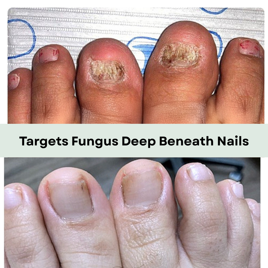 NailRenew Laser Device - Removes Nail Fungus, Onychomycosis & Nail Infections